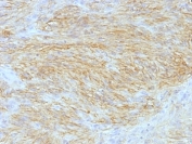 IHC: Formalin-fixed, paraffin-embedded human GIST stained with ANO1 antibody (clone SPM580).