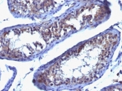 IHC: Formalin-fixed, paraffin-embedded human testicular carcinoma stained with anti-Prolactin Receptor antibody (SPM213).
