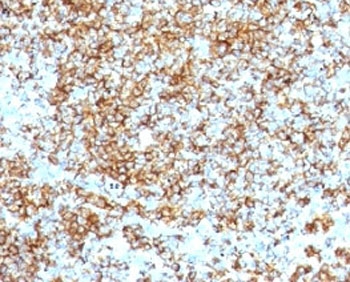 IHC: Formalin-fixed, paraffin-embedded human lymphoma stained with anti-CD45RB antibody (SPM569).~