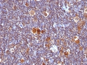 IHC analysis of formalin-fixed, paraffin-embedded human Hodgkin's lymphoma stained with anti-Bax antibody (clone SPM336).