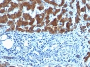 IHC: Formalin-fixed, paraffin-embedded human hepatocellular carcinoma stained with RBP (clone SPM442).