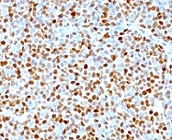 IHC: Formalin-fixed, paraffin-embedded human mantle cell lymphoma stained with CCND1 antibody.