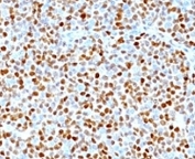 IHC: Formalin-fixed, paraffin-embedded human mantle cell lymphoma stained with CCND1 antibody (clone SPM587).