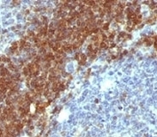 IHC analysis of formalin-fixed, paraffin-embedded human non-Hodgkin's lymphoma stained with anti-Bcl-2 antibody (clone SPM530).
