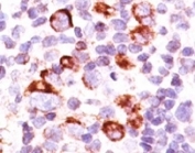 IHC: Formalin-fixed, paraffin-embedded human Hodgkin's lymphoma stained with anti-Bcl-X antibody (SPM165).