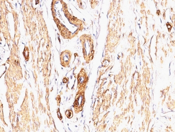 IHC: Formalin-fixed, paraffin-embedded Leiomyosarcoma stained with Smooth Muscle Actin antibody (clone SPM332).