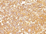 IHC: Formalin-fixed, paraffin-embedded human melanoma stained with gp100 antibody (SPM142).