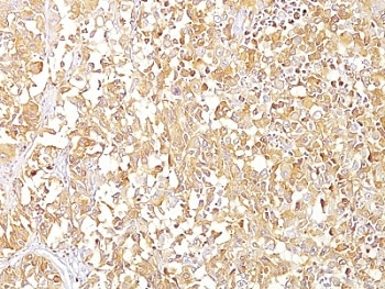 IHC: Formalin-fixed, paraffin-embedded human melanoma stained with gp100 antibody (SPM142).~