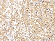 IHC: Formalin-fixed, paraffin-embedded human melanoma stained with gp100 antibody (SPM142).