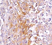 IHC: Formalin-fixed, paraffin-embedded human melanoma stained with anti-gp100 antibody (SPM286).