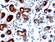 IHC: Formalin-fixed, paraffin-embedded human breast carcinoma stained with pS2 antibody (SPM573).