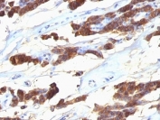 IHC: Formalin-fixed, paraffin-embedded human thyroid carcinoma stained with anti-Thyroglobulin antibody (SPM221).