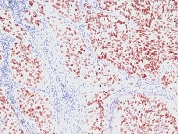 IHC: Formalin-fixed, paraffin-embedded human lung carcinoma stained with NKX2.1 antibody (clone SPM150).