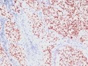 IHC: Formalin-fixed, paraffin-embedded human lung carcinoma stained with NKX2.1 antibody (clone SPM150).