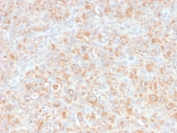 IHC staining of FFPE human histiocytoma with anti-TNF-alpha antibody. HIER: boil tissue sections in pH9 EDTA for 20 min and allow to cool before testing.