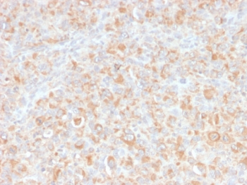 IHC staining of FFPE human histiocytoma with anti-TNF-alpha antibody. HIER: boil tissue sections in pH9 EDTA for 2