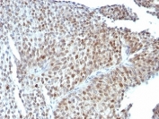IHC: Formalin-fixed, paraffin-embedded human bladder carcinoma stained with anti-p53 antibody (clone SPM589).