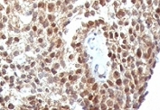 IHC: Formalin-fixed, paraffin-embedded human colon carcinoma stained with anti-p53 antibody (clone SPM590).