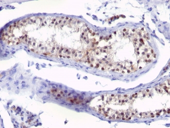 IHC: Formalin-fixed, paraffin-embedded human testicular carcinoma stained with anti-Thymidylate Synthase antibody (clone SPM453).