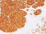 IHC: Formalin-fixed, paraffin-embedded human melanoma stained with Tyrosinase antibody (clone SPM360).