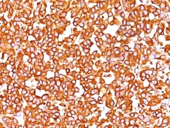 IHC: Formalin-fixed, paraffin-embedded human melanoma stained with VIM antibody (clone SPM576).~