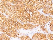 IHC: Formalin-fixed, paraffin-embedded human renal cell carcinoma stained with CA9 antibody (SPM314).