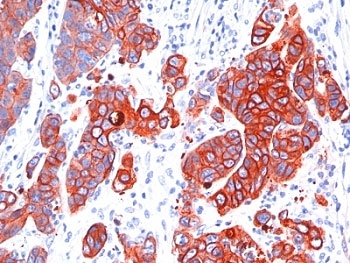 IHC: Formalin-fixed, paraffin-embedded human colon carcinoma stained with anti-Multi Cytokeratin antibody (SPM583).