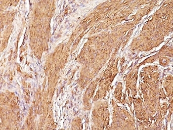 IHC: Formalin-fixed, paraffin-embedded human Leiomyosarcoma stained with Muscle Specific Actin antibody (clone SPM160).