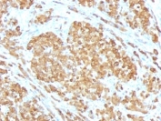 IHC: Formalin-fixed, paraffin-embedded human melanoma stained with Melan-A antibody (clone SPM555).