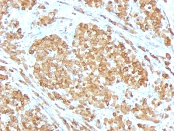 IHC: Formalin-fixed, paraffin-embedded human melanoma stained with Melan-A antibody (SPM555).