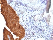 IHC: Formalin-fixed, paraffin-embedded human bladder carcinoma stained with Cytokeratin 19 antibody (clone SPM561).
