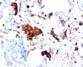 IHC staining of FFPE human lung tissue with recombinant Napsin A antibody (clone NAPSA/7043R). Negative control inset: PBS instead of primary antibody to control for secondary binding. HIER: boil tissue sections in pH 9 10mM Tris with 1mM EDTA for 20 min and allow to cool before testing.~