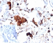 IHC staining of FFPE human lung tissue with recombinant Napsin A antibody (clone NAPSA/7043R). Negative control inset: PBS instead of primary antibody to control for secondary binding. HIER: boil tissue sections in pH 9 10mM Tris with 1mM EDTA for 20 min and allow to cool before testing.