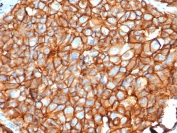 IHC staining of FFPE human breast carcinoma tissue with recombinant ErbB2 antibody (clone ERBB2/4376R) at 2ug/ml in PBS for 30min RT. HIER: boil tissue sections in pH 9 10mM Tris with 1mM EDTA for 20 min and allow to cool before testing.