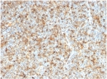 IHC staining of FFPE human follicular lymphoma tissue with LMO2 antibody (clone LMO2/1972). HIER: boil tissue sections in pH 9 10mM Tris with 1mM EDTA for 20 min and allow to cool before testing.
