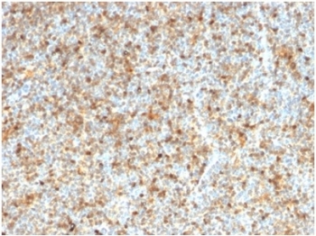 IHC staining of FFPE human follicular lymphoma ti