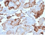 IHC staining of FFPE human breast carcinoma tissue with BPIFB1 antibody (clone LPLUNC1/3206). HIER: boil tissue sections in pH 9 10mM Tris with 1mM EDTA for 20 min and allow to cool before testing.