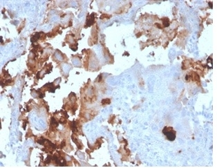 IHC staining of FFPE human breast carcinoma tissue with BPIFB1 antibody (clone LPLUNC1/3206). HIER: boil tissue sections in pH 9 10mM Tris with 1mM EDTA for 20 min and allow to cool before testing.~