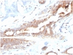 IHC staining of FFPE human breast carcinoma tissue with Lactoferrin antibody (clone LTF/4082). HIER: boil tissue sections in pH 9 10mM Tris with 1mM EDTA for 20 min and allow to cool before testing.