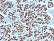 IHC staining of FFPE human breast carcinoma tissue with recombinant Cyclin E1 antibody (clone rCCNE1/4936). HIER: boil tissue sections in pH 9 10mM Tris with 1mM EDTA for 20 min and allow to cool before testing.