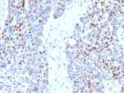 IHC staining of FFPE human ovarian carcinoma tissue with recombinant Cyclin E antibody (clone rCCNE1/4936). HIER: boil tissue sections in pH 9 10mM Tris with 1mM EDTA for 20 min and allow to cool before testing.