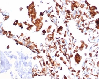 IHC staining of FFPE human lung adenocarcinoma tissue with recombinant Napsin A antibody (clone rNAPSA/6926). Negative control inset: PBS instead of primary antibody to control for secondary binding. HIER: boil tissue sections in pH 9 10mM Tris with 1mM EDTA for 20 min and allow to cool before testing.~