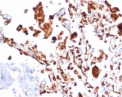 IHC staining of FFPE human lung adenocarcinoma tissue with recombinant Napsin A antibody (clone rNAPSA/6926). Negative control inset: PBS instead of primary antibody to control for secondary binding. HIER: boil tissue sections in pH 9 10mM Tris with 1mM EDTA for 20 min and allow to cool before testing.