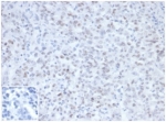 IHC staining of FFPE Lynch Syndrome / Hereditary Non-Polyposis Colorectal Cancer (HNPCC) with MLH1 antibody (clone MLH1/6467) at 2ug/ml in PBS, 30 min RT. Negative control inset: PBS instead of primary antibody to control for secondary binding. HIER: boil tissue sections in pH 9 10mM Tris with 1mM EDTA for 20 min and allow to cool before testing.