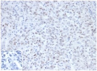 IHC staining of FFPE Lynch Syndrome / Hereditary Non-Polyposis Colorectal Cancer tissue (HNPCC) with MLH1 antibody (clone MLH1/6467) at 2ug/ml in PBS, 30 min RT. Negative control inset: PBS instead of primary antibody to control for secondary binding. HIER: boil tissue sections in pH 9 10mM Tris with 1mM EDTA for 20 min and allow to cool before testing.