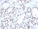 IHC staining of FFPE human ovarian carcinoma tissue with MLH1 antibody (clone MLH1/6467). HIER: boil tissue sections in pH 9 10mM Tris with 1mM EDTA for 20 min and allow to cool before testing.