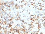 IHC staining of FFPE human bladder carcinoma tissue with Cytokeratin 17 antibody (clone KRT17/4604). HIER: boil tissue sections in pH 9 10mM Tris with 1mM EDTA for 20 min and allow to cool before testing.