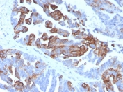 IHC staining of FFPE human prostate tissue with Cytokeratin 17 antibody (clone KRT17/4604). HIER: boil tissue sections in pH 9 10mM Tris with 1mM EDTA for 20 min and allow to cool before testing.
