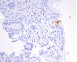 IHC staining of FFPE human H. pylori-infected stomach tissue with H pylori Catalase antibody (clone HPYL/7170). HIER: boil tissue sections in pH 9 10mM Tris with 1mM EDTA for 20 min and allow to cool before testing.