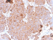 IHC staining of FFPE human pituitary carcinoma tissue with Prolactin antibody (clone PRL/4908R). HIER: boil tissue sections in pH 9 10mM Tris with 1mM EDTA for 20 min and allow to cool before testing.
